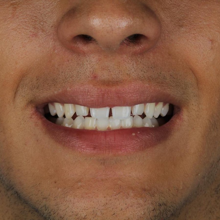 Sorriso antes do tratamento — caso 1