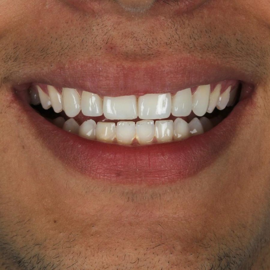 Sorriso depois do tratamento — caso 1