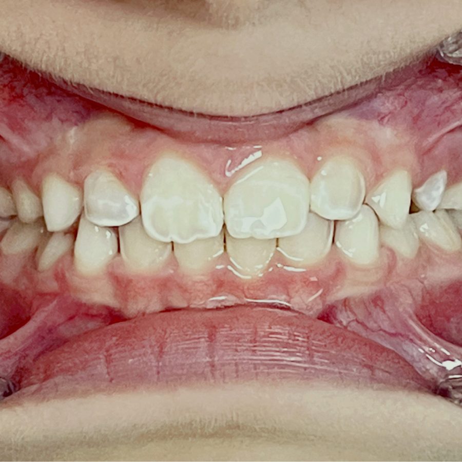 Sorriso depois do tratamento — caso 2