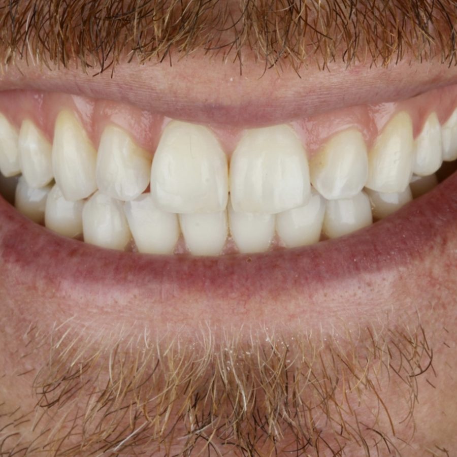 Sorriso depois do tratamento — caso 3