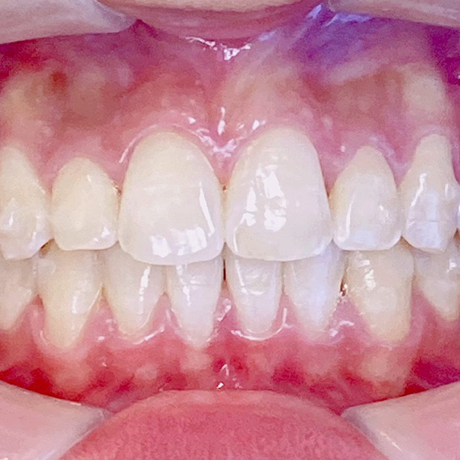 Sorriso depois do tratamento — caso 4