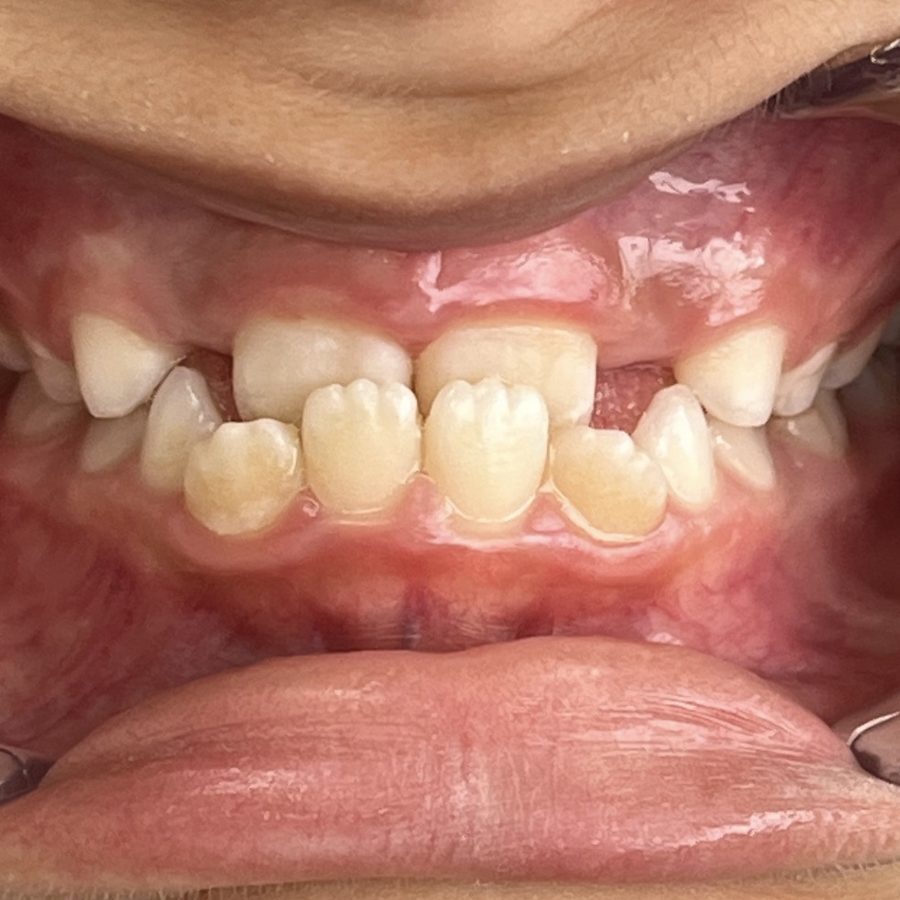 Sorriso antes do tratamento — caso 5
