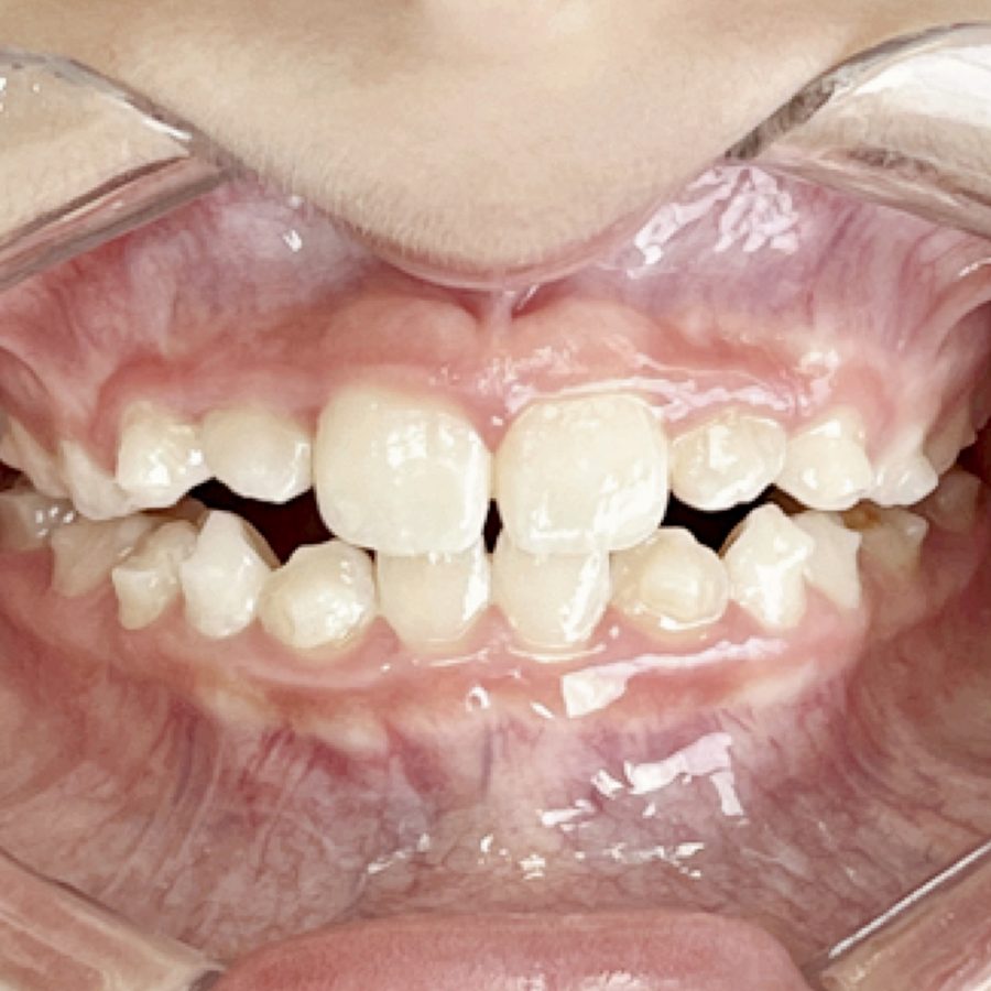 Sorriso depois do tratamento — caso 5