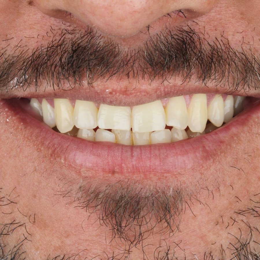 Sorriso antes do tratamento — caso 6