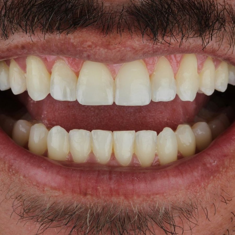 Sorriso depois do tratamento — caso 6