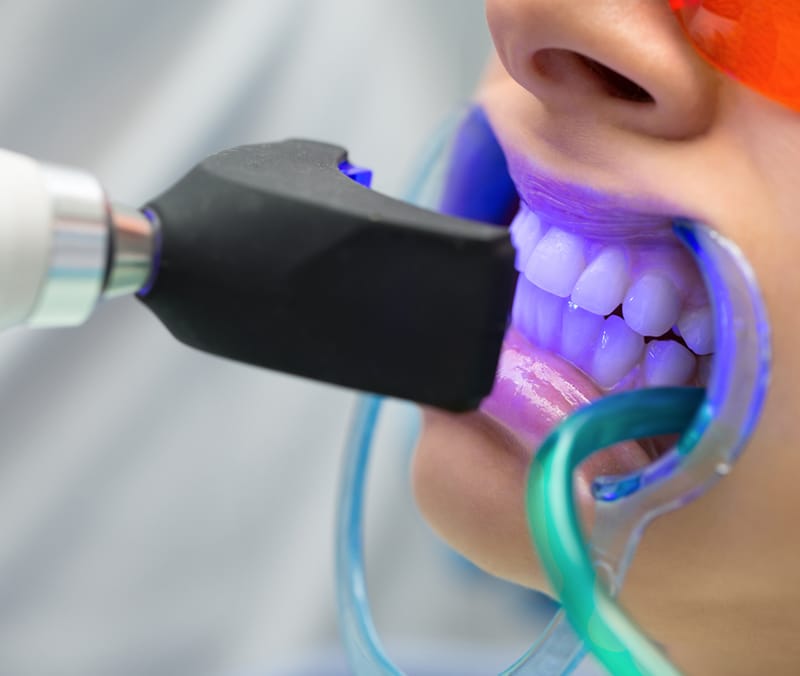 Clareamento em consultório: afastador labial e luz de fotoativação sobre os dentes