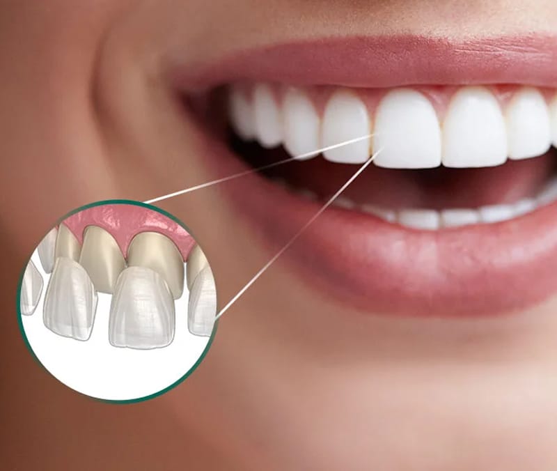 Sorriso com detalhe ampliado das lentes de contato aplicadas sobre os dentes